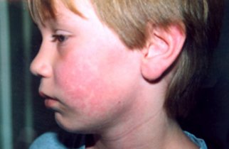 Erythema infectiosum